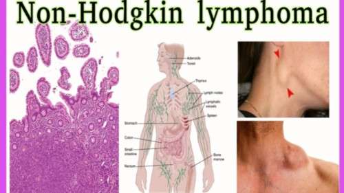 Non-Hodgkin Lymphoma: Symptoms, Treatment, and Success Rate