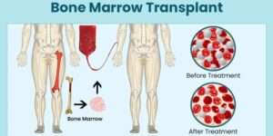 Bone Marrow Transplant in India: Procedure, Cost & Best Hospitals