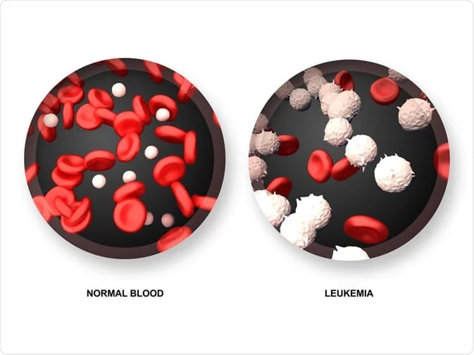 Chronic Leukemia Treatment in India