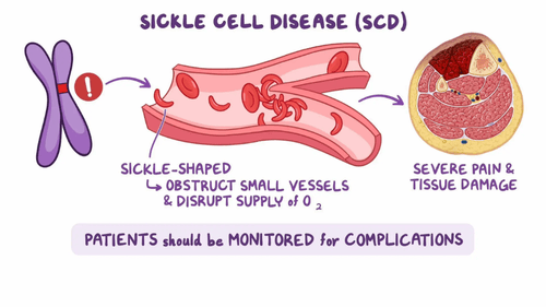 Sickle Cell Disease Treatment Cost in India