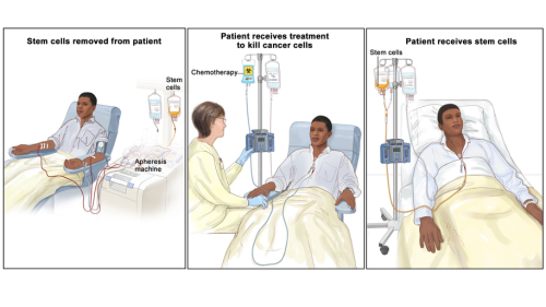 Autologous Stem Cell Transplant Cost in India