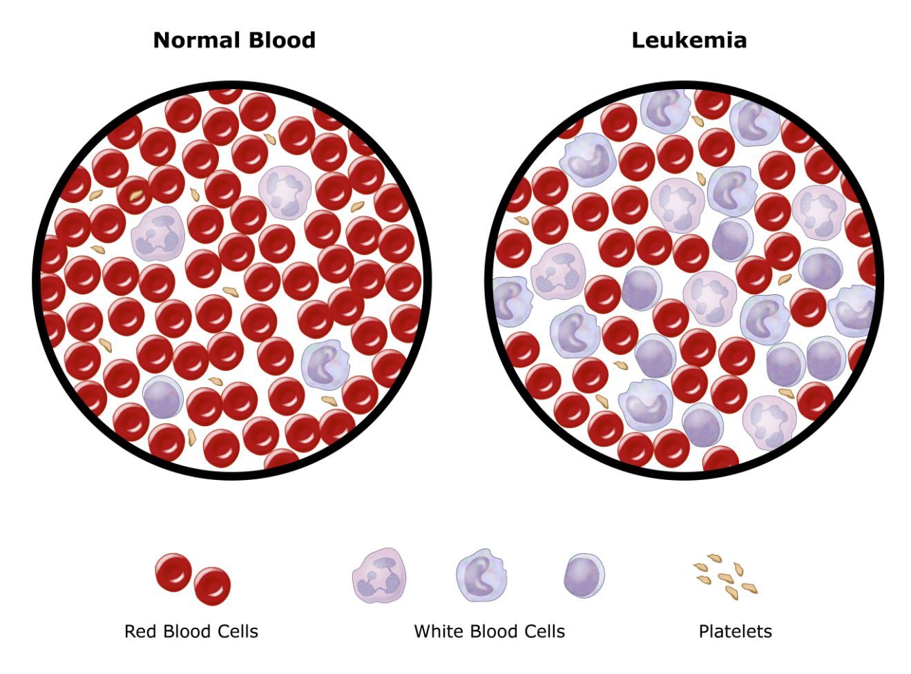 Leukemia Treatment Cost in India