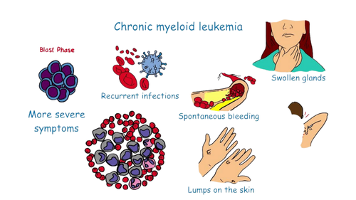 Chronic Myelogenous Leukemia (CML) Treatment Cost in India