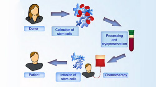 Allogeneic Stem Cell Transplant Cost in India