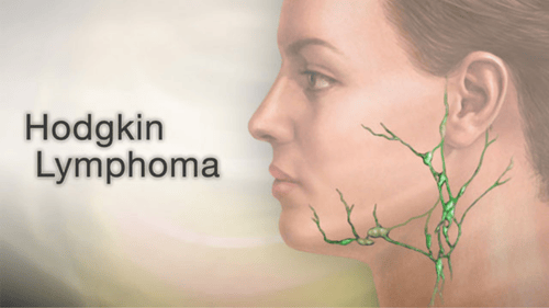 Hodgkin's Lymphoma Treatment Cost in India