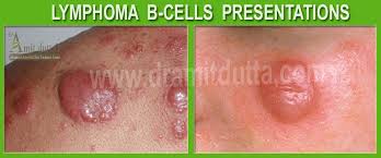 B-Cell Lymphoma Treatment Cost in India