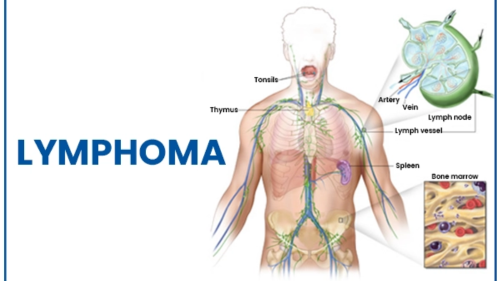 Lymphoma Treatment Cost in India