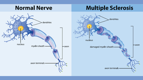 Multiple Sclerosis Treatment in India
