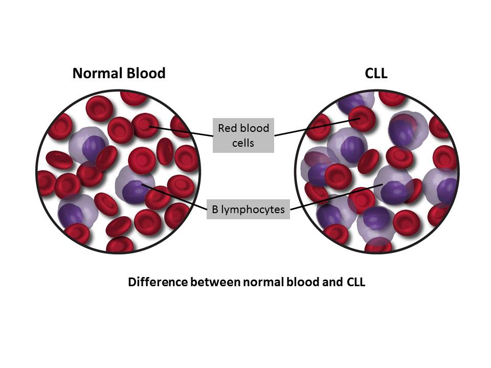 Chronic Lymphocytic Leukemia (CLL) Treatment Cost in India