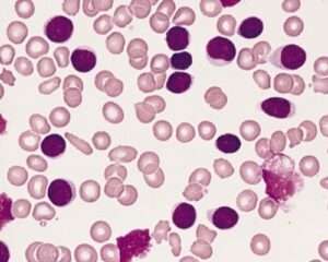 Acute Lymphocytic Leukemia