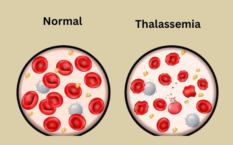 Thalassemia