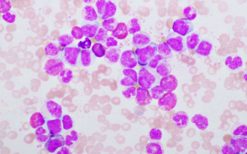 Chronic Myelogenous Leukemia