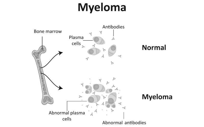 myeloma treatment in India