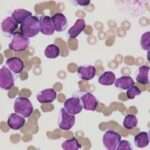 acute lymphoblastic leukemia