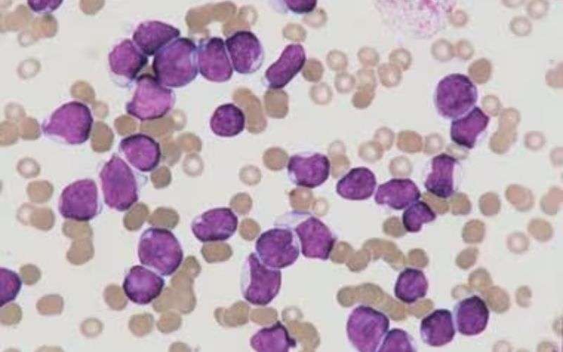 acute lymphoblastic leukemia