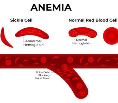 Sickle Cell Anemia Treatment in India