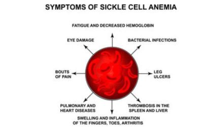 Symptoms of sickle cell anemia