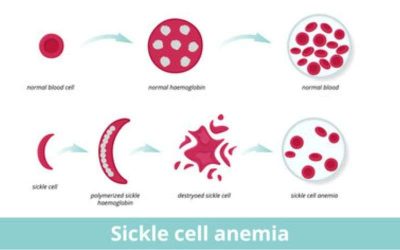 sickle cell anemia