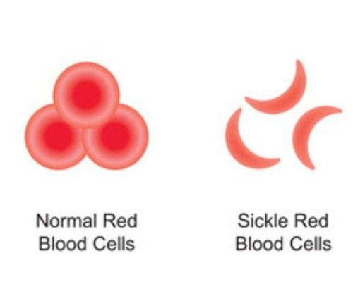 Sickle Cell disease