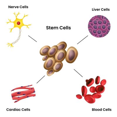 stem cell transplant